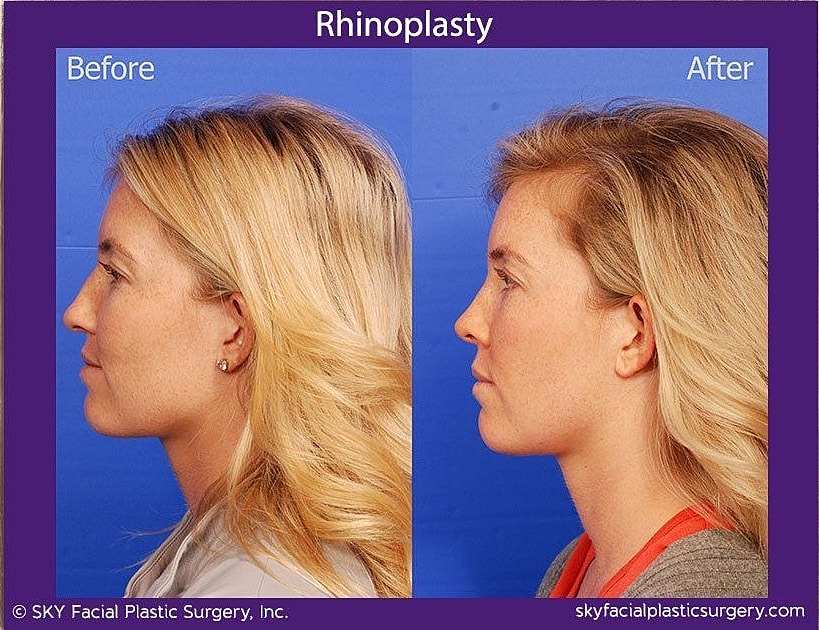 Rhinoplasty Before & After