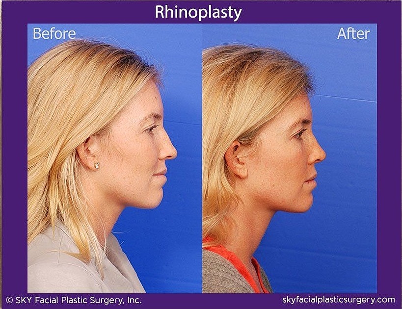 Rhinoplasty Before & After