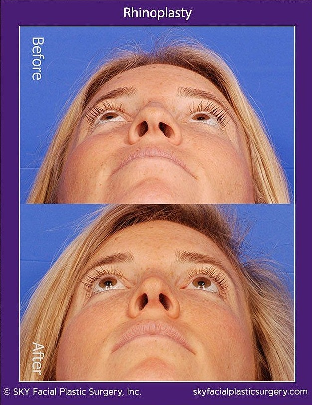 Rhinoplasty Before & After