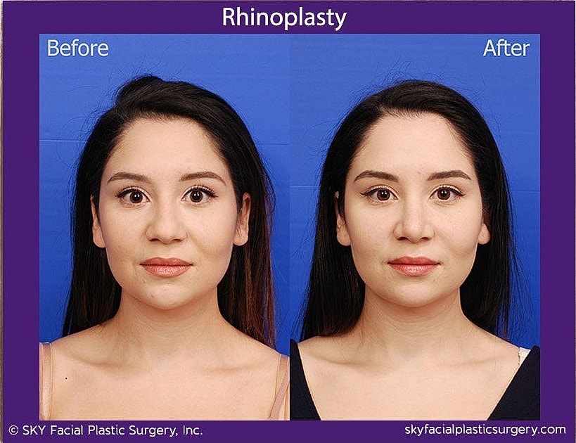 Rhinoplasty Before & After