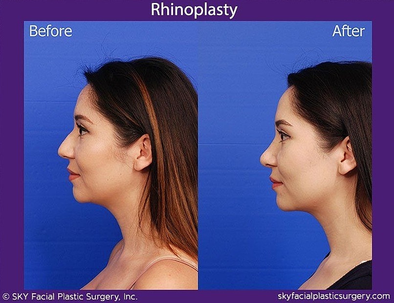 Rhinoplasty Before & After