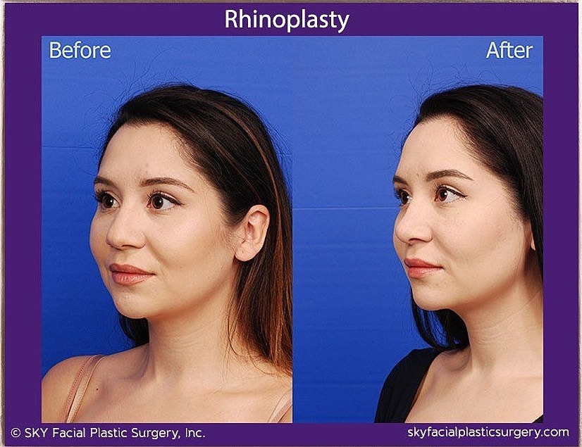 Rhinoplasty Before & After