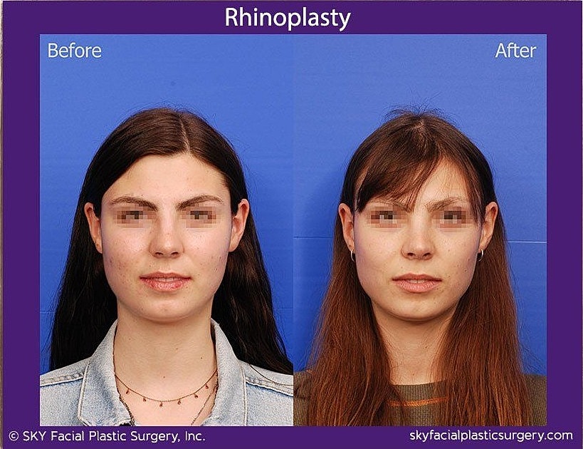 Rhinoplasty Before & After