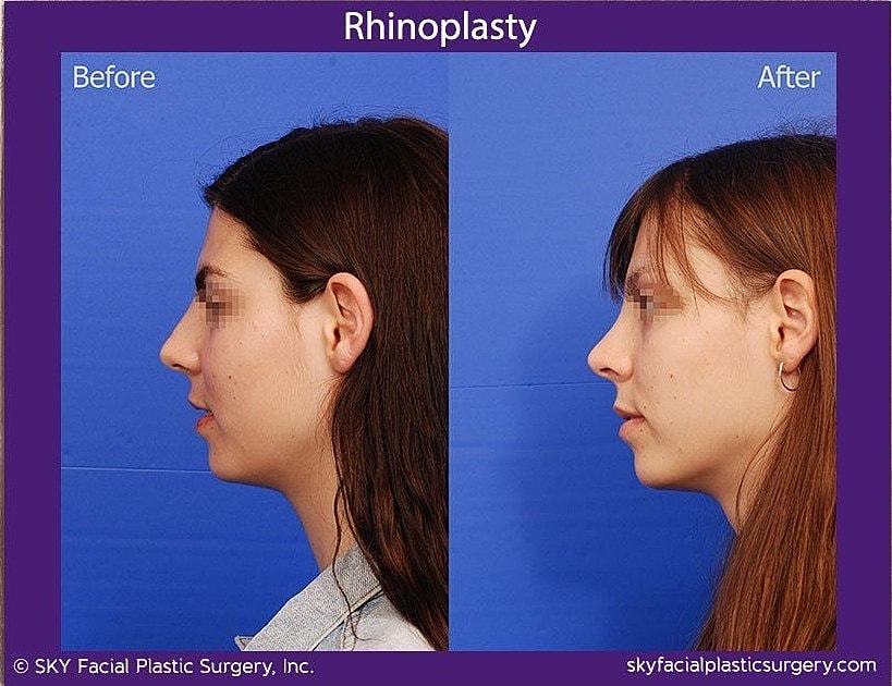Rhinoplasty Before & After