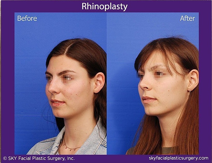 Rhinoplasty Before & After