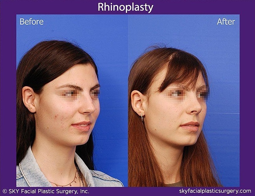 Rhinoplasty Before & After