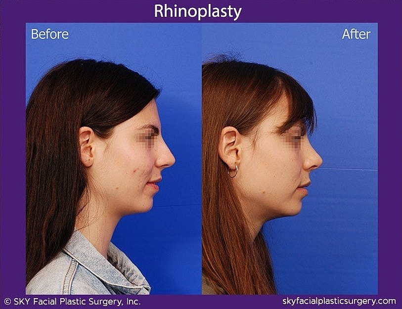 Rhinoplasty Before & After