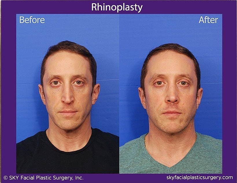Rhinoplasty Before & After
