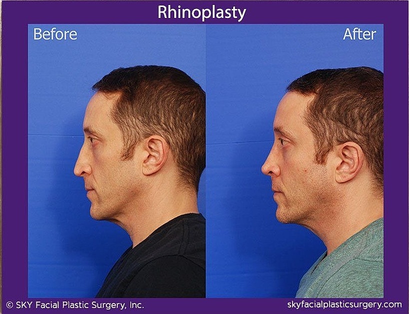Rhinoplasty Before & After