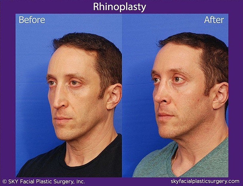 Rhinoplasty Before & After