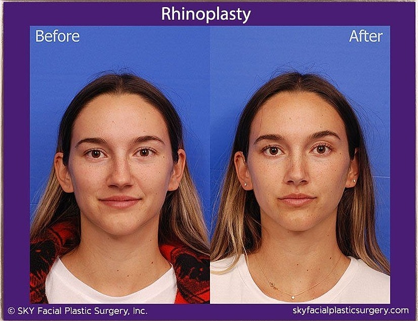 Rhinoplasty Before & After