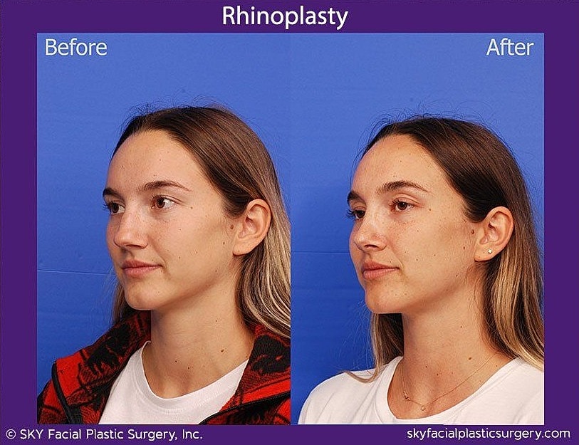 Rhinoplasty Before & After