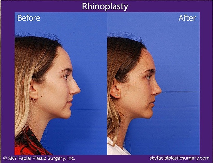 Rhinoplasty Before & After