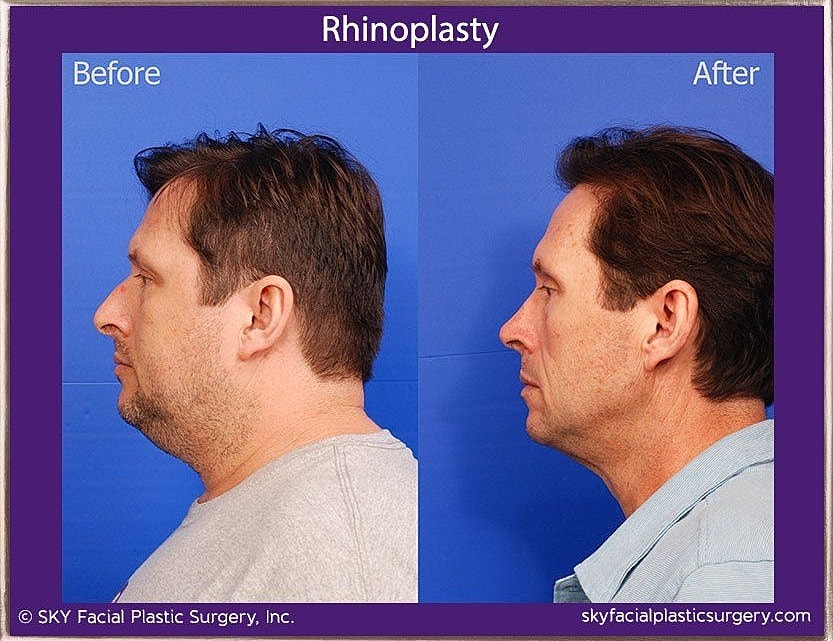 Rhinoplasty Before & After