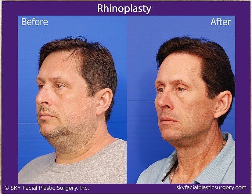 Rhinoplasty Before & After