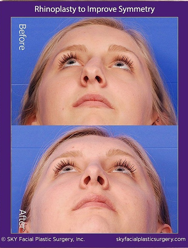 Rhinoplasty Before & After