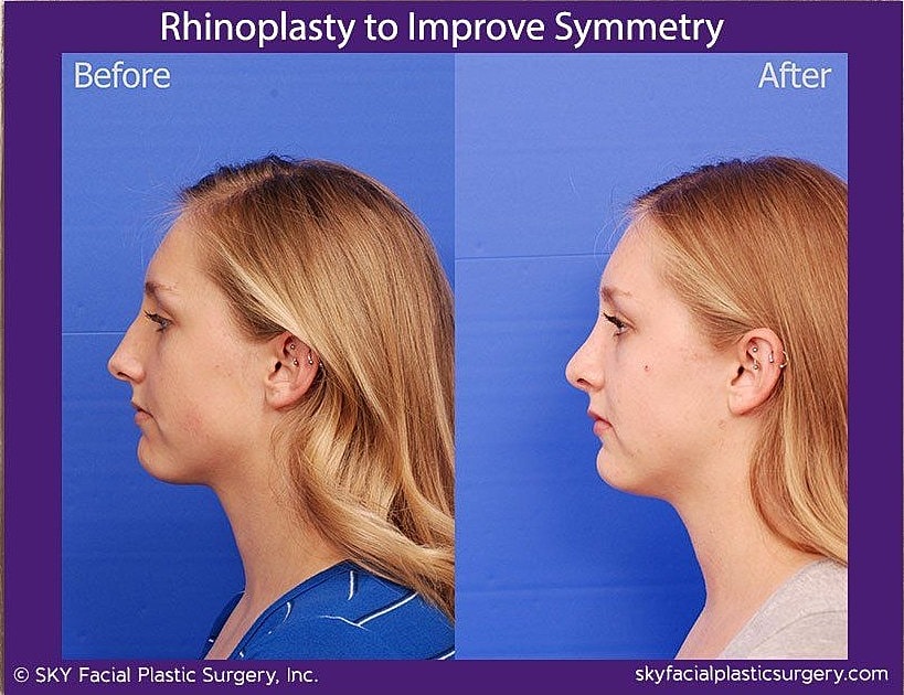 Rhinoplasty Before & After
