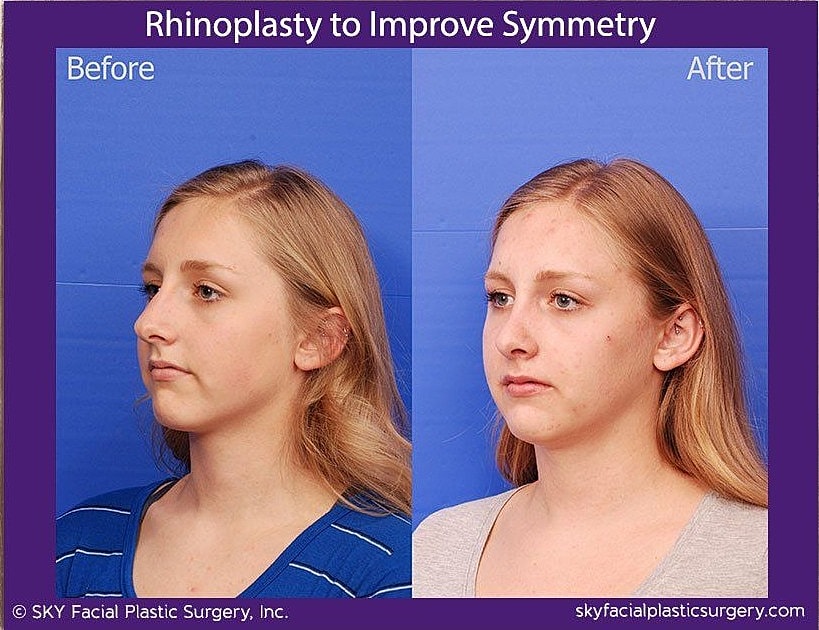 Rhinoplasty Before & After