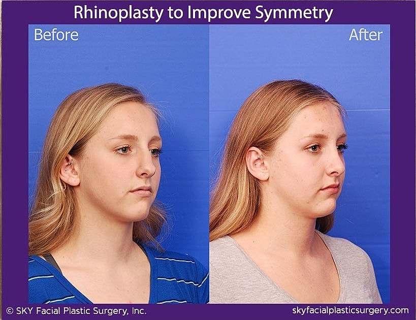 Rhinoplasty Before & After