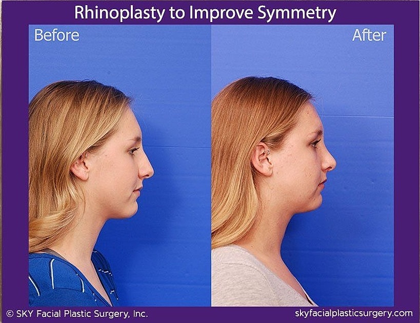 Rhinoplasty Before & After