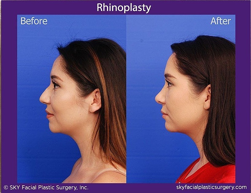 Rhinoplasty Before & After