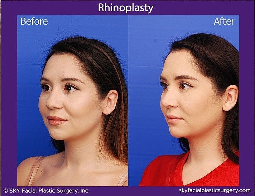 Rhinoplasty Before & After