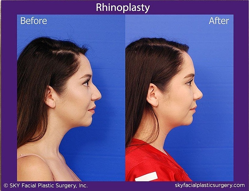 Rhinoplasty Before & After