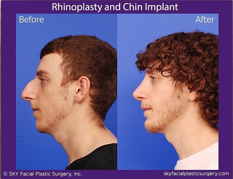 Rhinoplasty Before & After