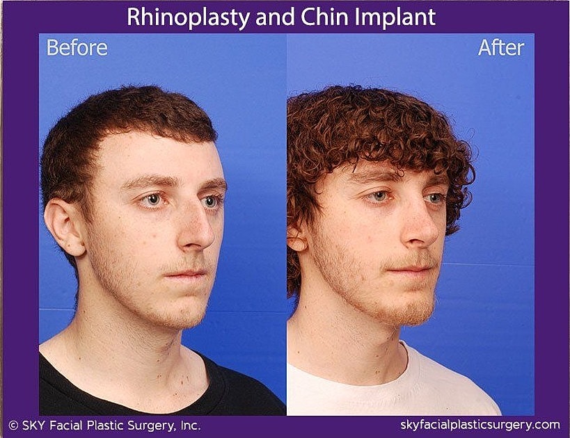Rhinoplasty Before & After