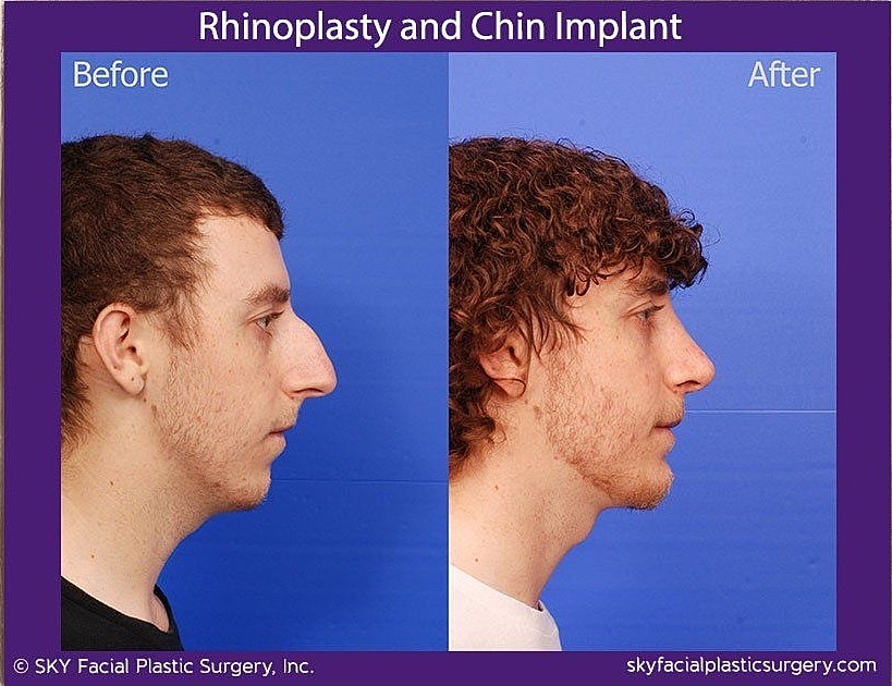 Rhinoplasty Before & After