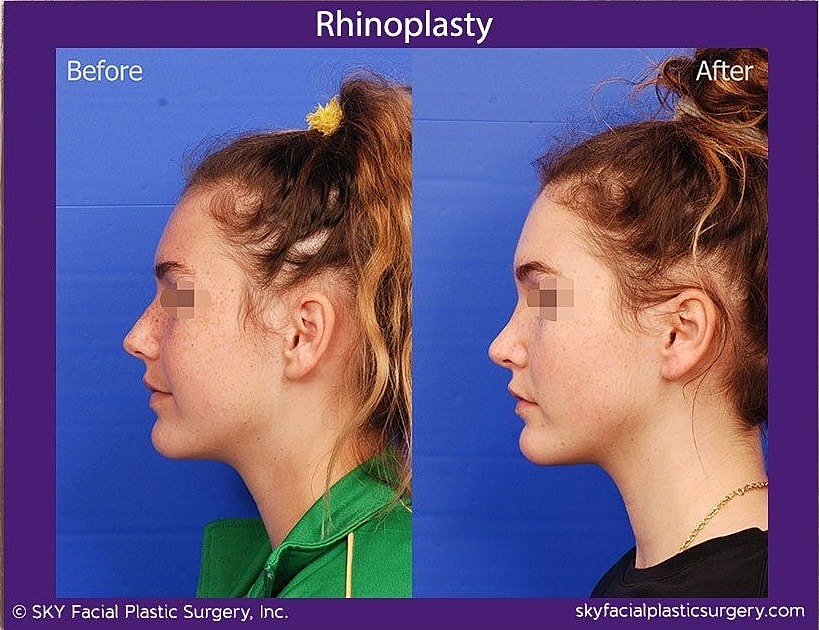 Rhinoplasty Before & After