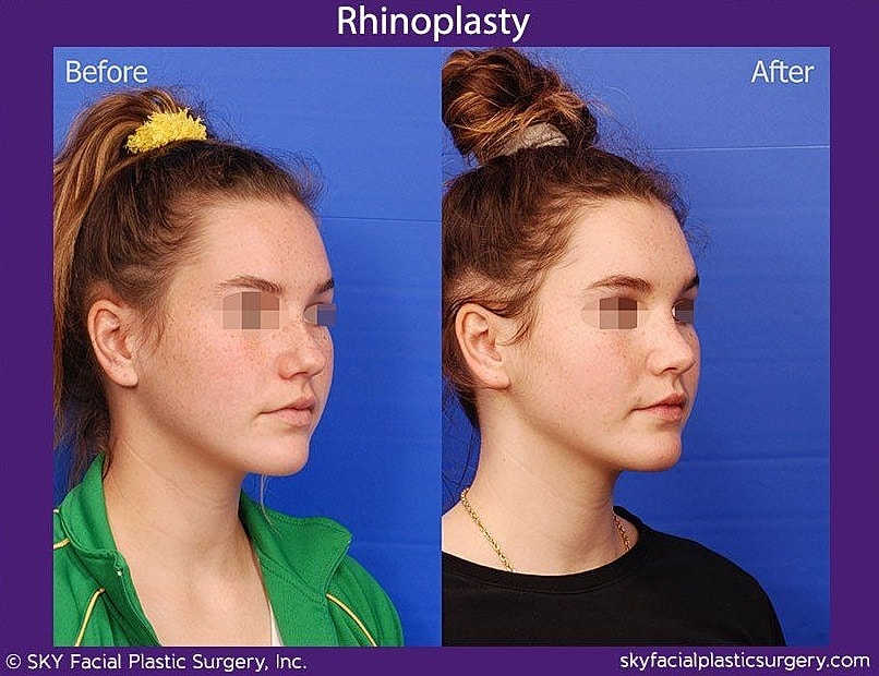 Rhinoplasty Before & After
