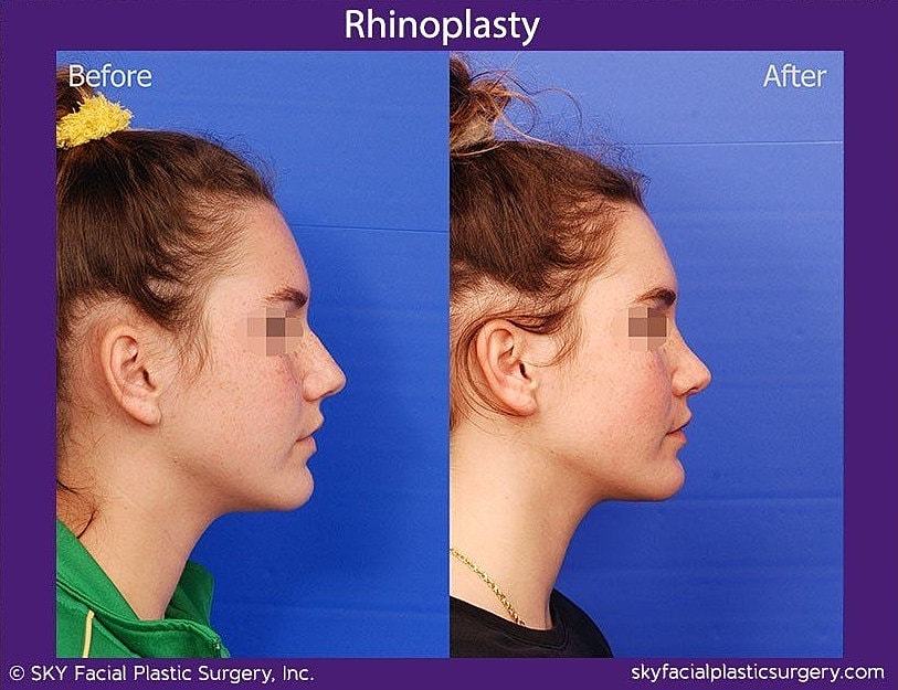 Rhinoplasty Before & After