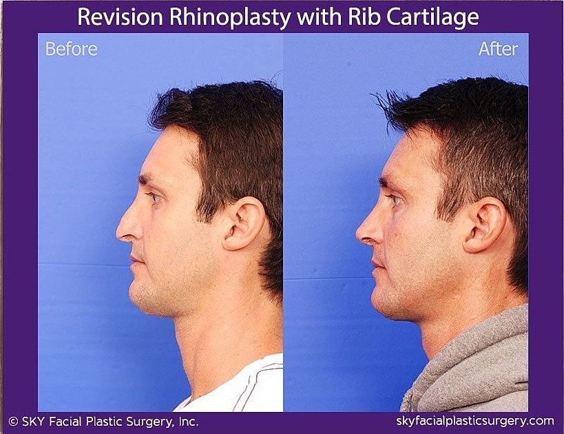 Rhinoplasty Before & After