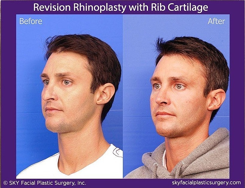 Rhinoplasty Before & After