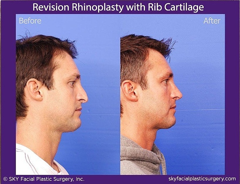 Rhinoplasty Before & After