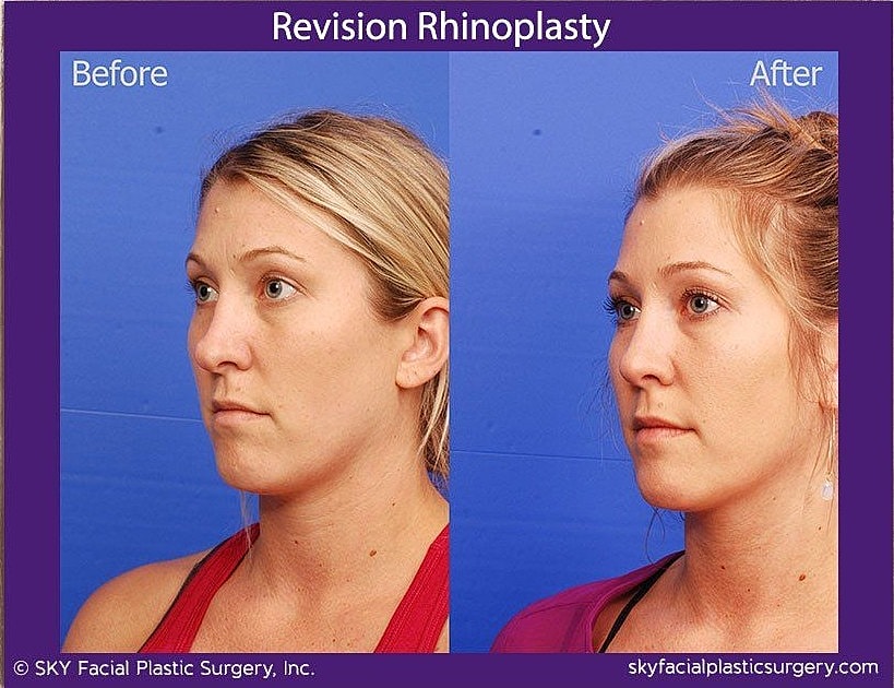 Rhinoplasty Before & After