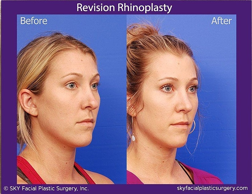 Rhinoplasty Before & After