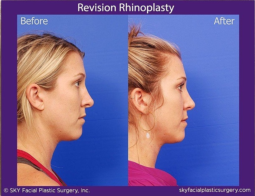 Rhinoplasty Before & After