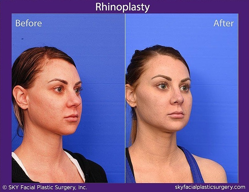 Rhinoplasty Before & After