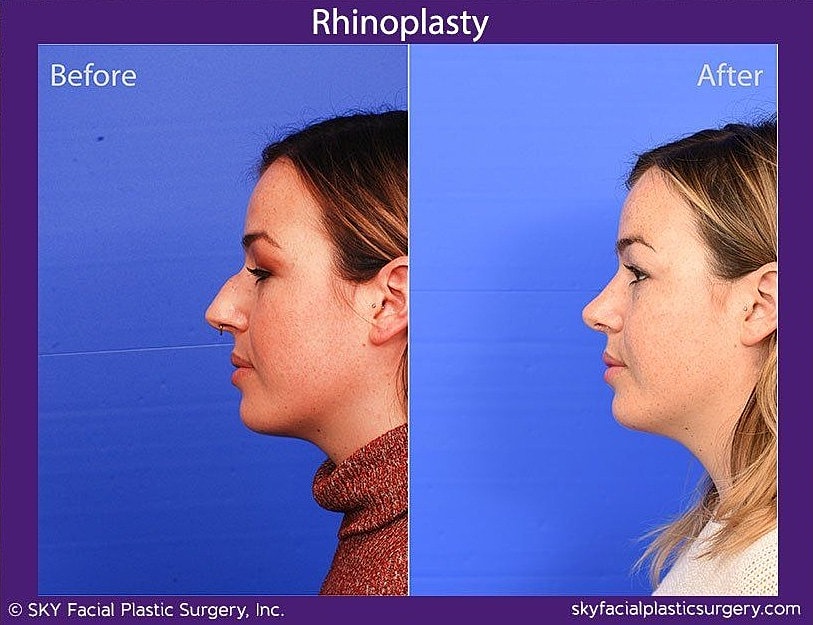 Rhinoplasty Before & After