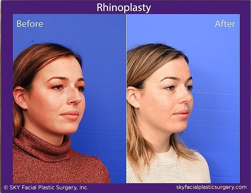 Rhinoplasty Before & After