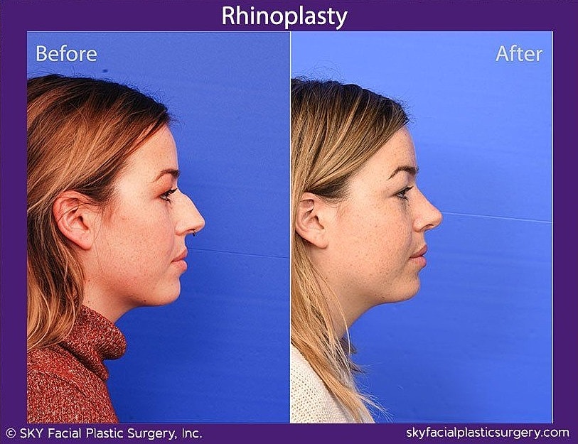 Rhinoplasty Before & After
