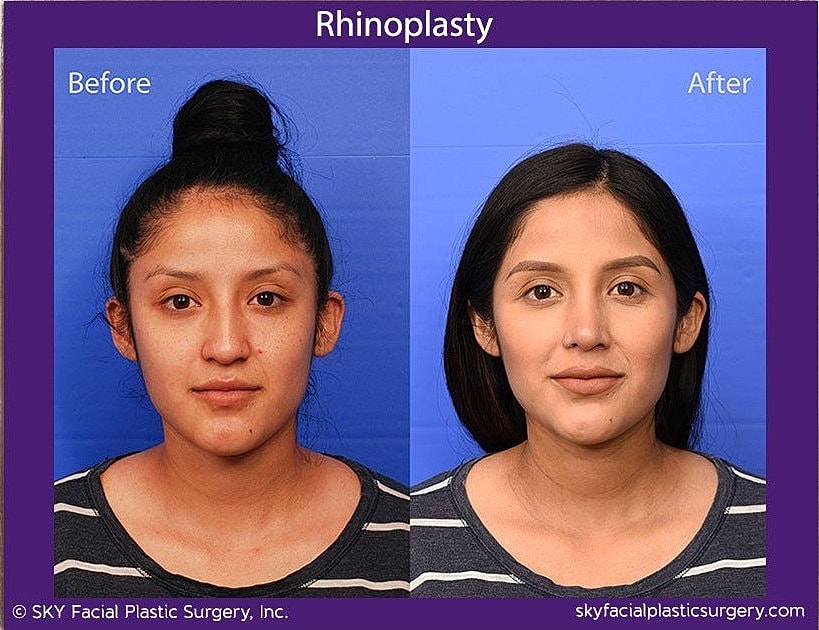 Rhinoplasty Before & After