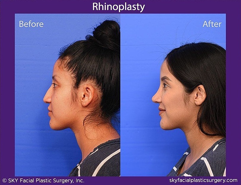 Rhinoplasty Before & After