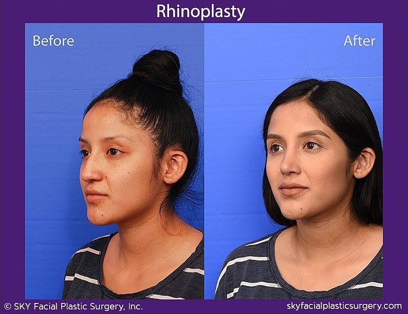 Rhinoplasty Before & After