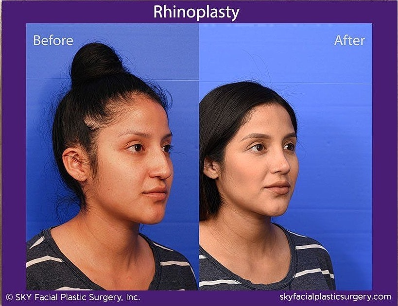 Rhinoplasty Before & After