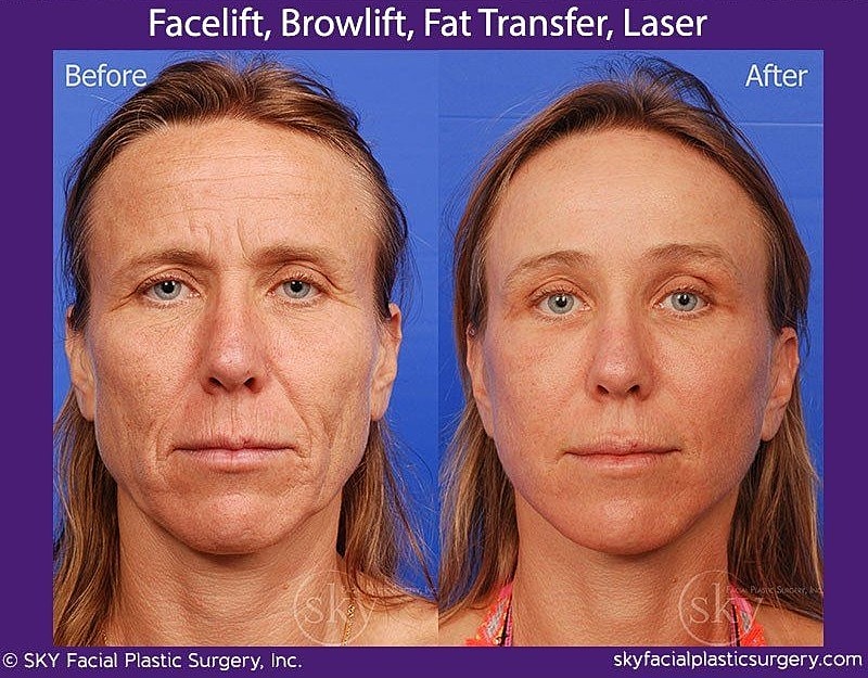 Facelift Before & After