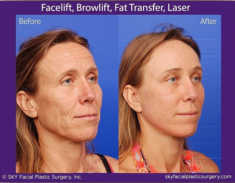 Facelift Before & After