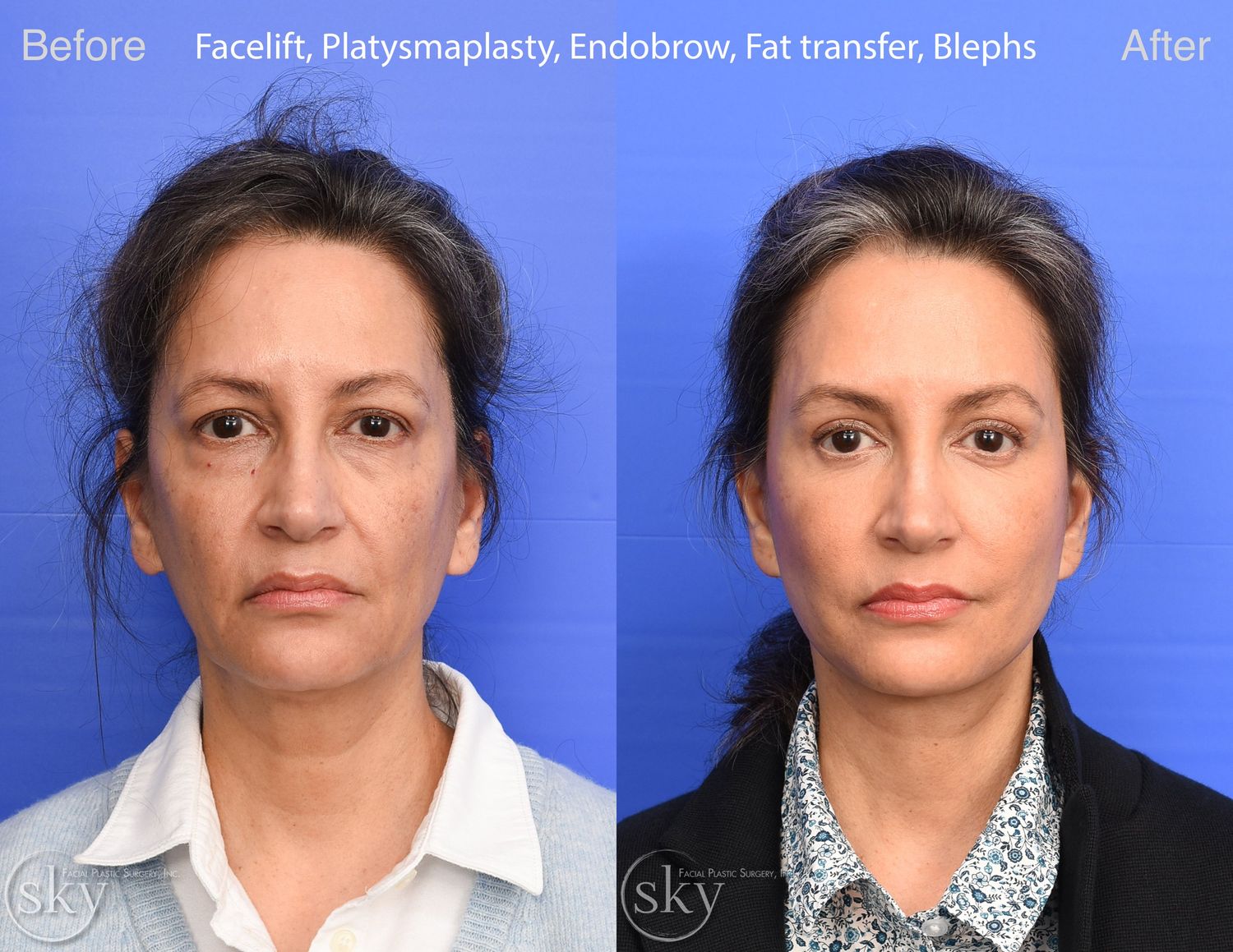 Facelift Before & After